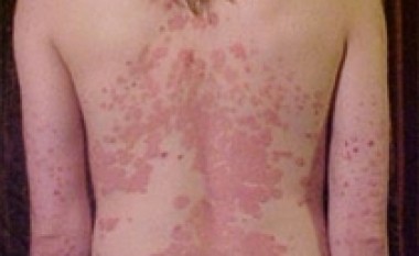 Kremi i ri për psoriazën