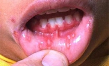 Bar i ri për herpes?