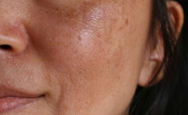 Çfarë është melasma? Pjesët e njollosura në lëkurën tuaj që errësohen në diell