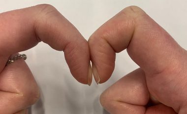 Testi në dy sekonda: Lidhni të dy gishtat tregues dhe zbuloni nëse jeni të kërcënuar nga një sëmundje të rrezikshme!