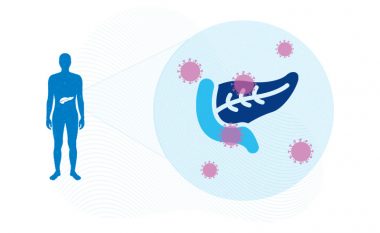 COVID-19 prek pankreasin e një personi duke rritur rrezikun e diabetit, sipas një studim të ri