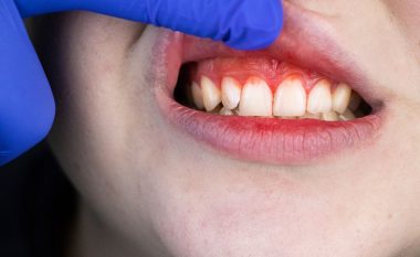 Çfarë ju tregojnë gjakderdhja dhe zmbrapsja e mishrave të dhëmbëve për shëndetin tuaj