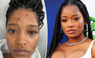 Keke Palmer shprehet e sinqertë për puçrrat: Jam e lodhur prej tyre