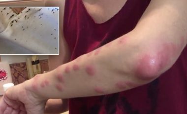 Çimkat – shenjat e zakonshme që jeni kafshuar dhe keni marr infeksion