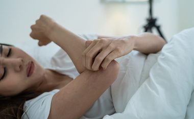 Ju ka pickuar mushkonja? Kjo është mënyra se si po atë çast të zhduken ënjtja dhe skuqja