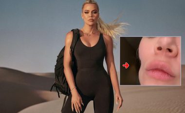 Khloe Kardashian tregon fytyrën pas operacionit për heqjen e një forme të kancerit të lëkurës