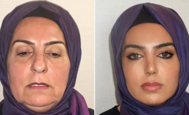 A është i njëjti person? – Njerëzit nuk mund ta besojnë ndryshimin e madh pas ndërhyrjeve që bëri kjo grua në një klinikë në Turqi
