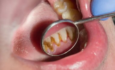 Ju formohen gurët e zi në dhëmbë? Si t’i largoni dhe si mund të parandaloni formimin e tyre