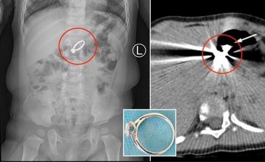 Kinezja 15-muajshe gëlltiti unazën e ëmës me gurë diamanti – detyrohet t’i nënshtrohet ndërhyrjes kirurgjikale për t’ia larguar  