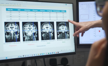 Mjeti i ri me Al mund të ndihmojë në betejën kundër Alzheimerit