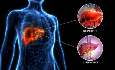 Cirroza hepatite, qasje e shkurtë