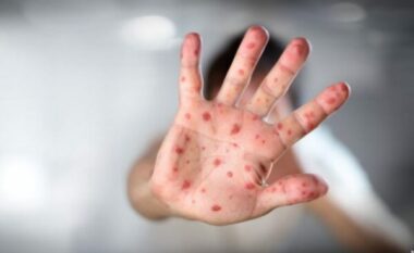 IKSHPK: Nga data 5 deri më 13 maj 2025 janë regjistruar 9 raste të fruthit në Kosovë