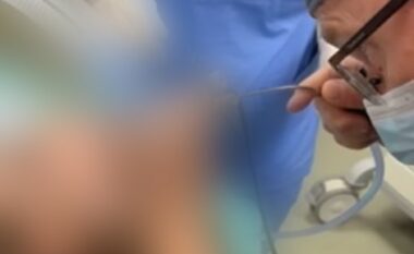 Shpëtohet jeta e një 5-vjeçari në Klinikën e ORL-së, i ishin bllokuar rrugët e frymëmarrjes nga një farë e lulediellit