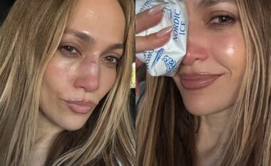 Jennifer Lopez pëson aksident teksa po përgatitej për një performancë, tregon mavijosjet në fytyrë