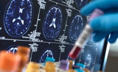 Testi i ri i gjakut zbulon me 95% saktësi shenjat e hershme të Alzheimerit