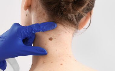 A duhet të hiqet lythi? Shenjat që kërkojnë ekzaminim urgjent dermatologjik