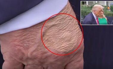 Disa shenja shfaqen në dorën e Trumpit, ekspertët zbulojnë se çfarë janë ato në të vërtetë