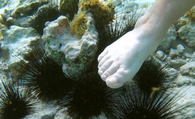 Therja nga iriqi i detit mund të shkaktojë ndalimin e frymëmarrjes, madje mund të rrezikojë jetën