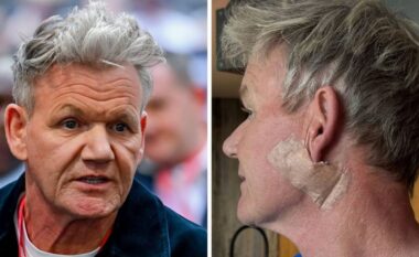 Gordon Ramsay zbulon se iu nënshtrua operacionit për heqjen e kancerit të lëkurës